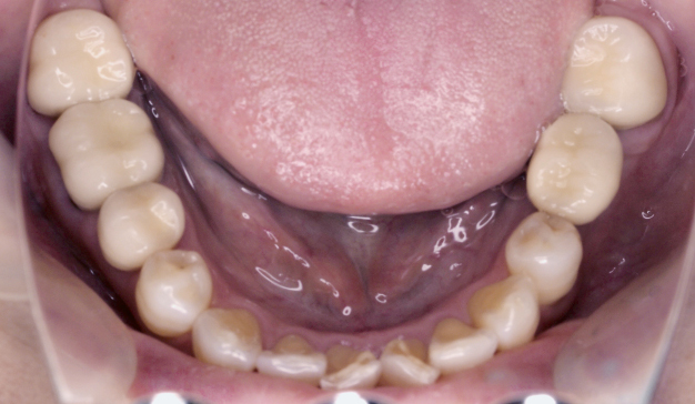 ジルコニア補綴＆そのほかの上顎歯牙のホワイトニング完了時