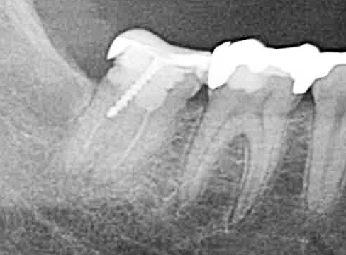 貴方の受けた根管治療によって、歯がどれぐらいもちますか？