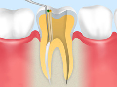 重度のむし歯には根管治療で対応