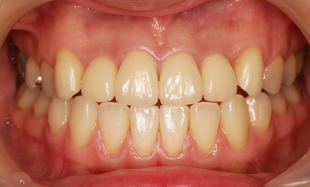 ジルコニア補綴＆そのほかの上顎歯牙のホワイトニング完了時