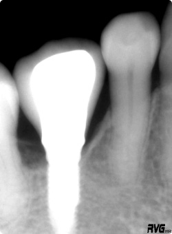 ネオデントインプラントの<br />
								レントゲン図