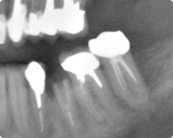 術全残根状態レントゲン