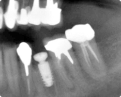 インプラント埋入直後レントゲン