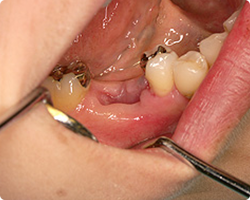 抜歯後1カ月：早期インプラント埋入と同時GBR法手術前