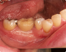 2年経過後の口腔内の状態
