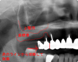 ソケットリフト術前パノラマレントゲン写真