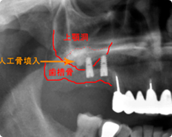 ソケットリフト術後パノラマレントゲン写真