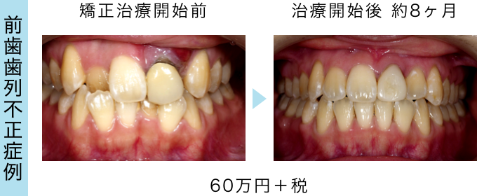 当院でのアライナー矯正の症例