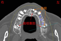 CT画像水平断