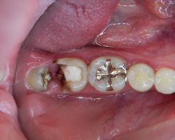 歯牙移植前口腔内写真