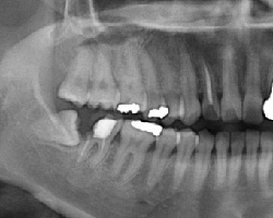 歯牙移植前X線写真