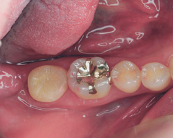 歯牙移植後口腔内写真