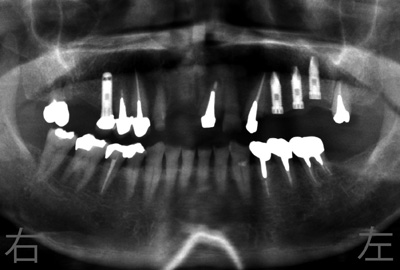 歯根嚢胞の診断の話