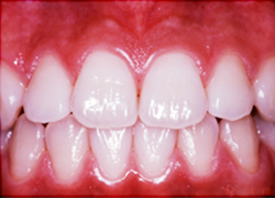 正常歯周組織の歯肉と重度な歯周病に罹患した歯肉の話