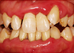 正常歯周組織の歯肉と重度な歯周病に罹患した歯肉の話