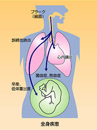 歯周病と全身疾患の関係